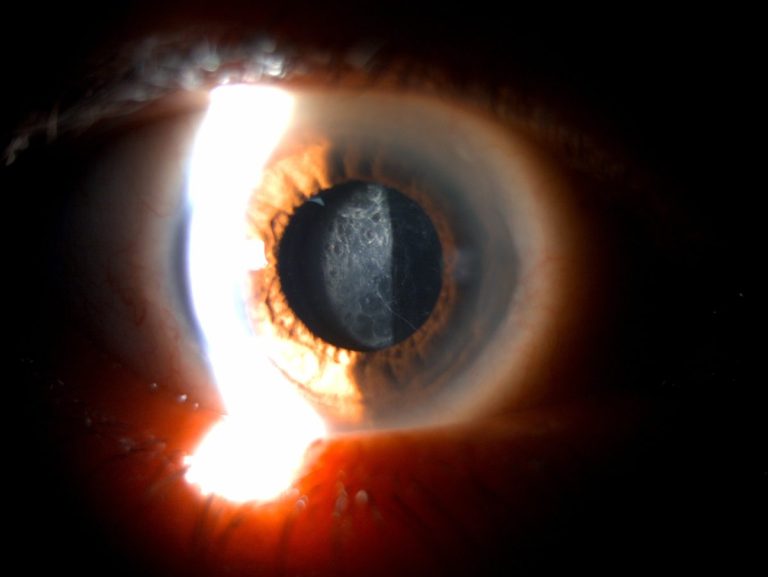 Photo à la lampe à fente d'une opacification capsulaire postérieure, dite cataracte secondaire