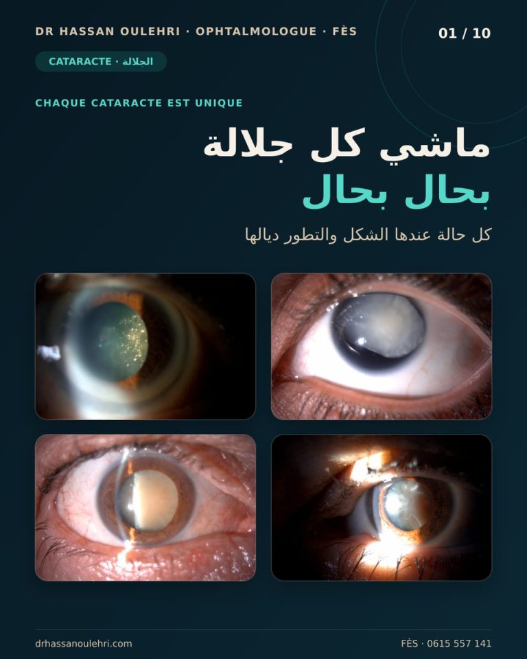 Formes de cataracte : nucléaire, corticale, sous-capsulaire, blanche et brune